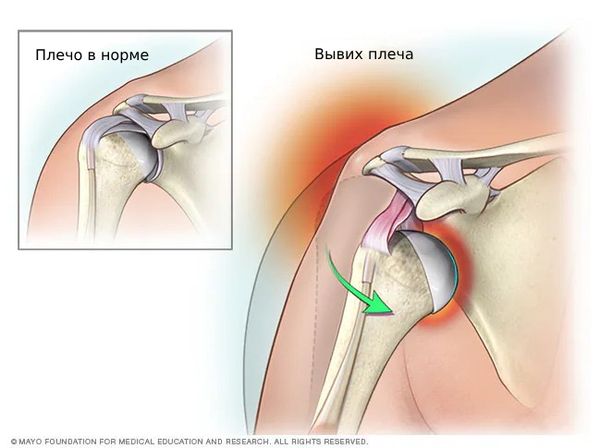Как отличить неполный перелом от вывиха: ключевые признаки и советы